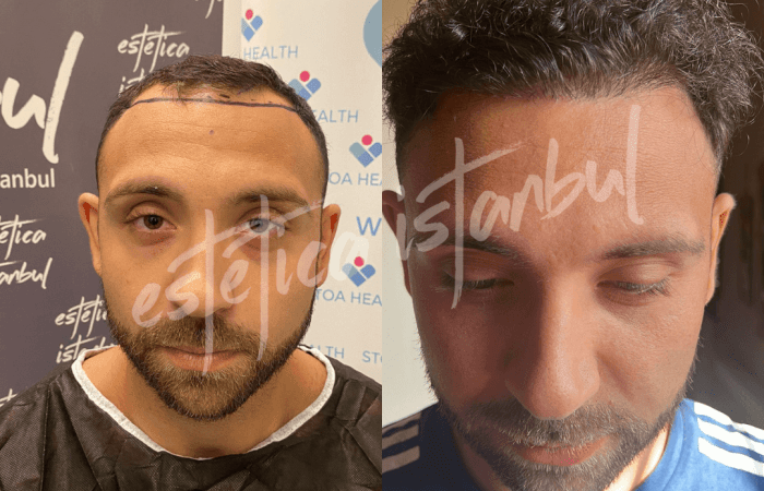 Aftercare tips for hair transplant patients in Turkey