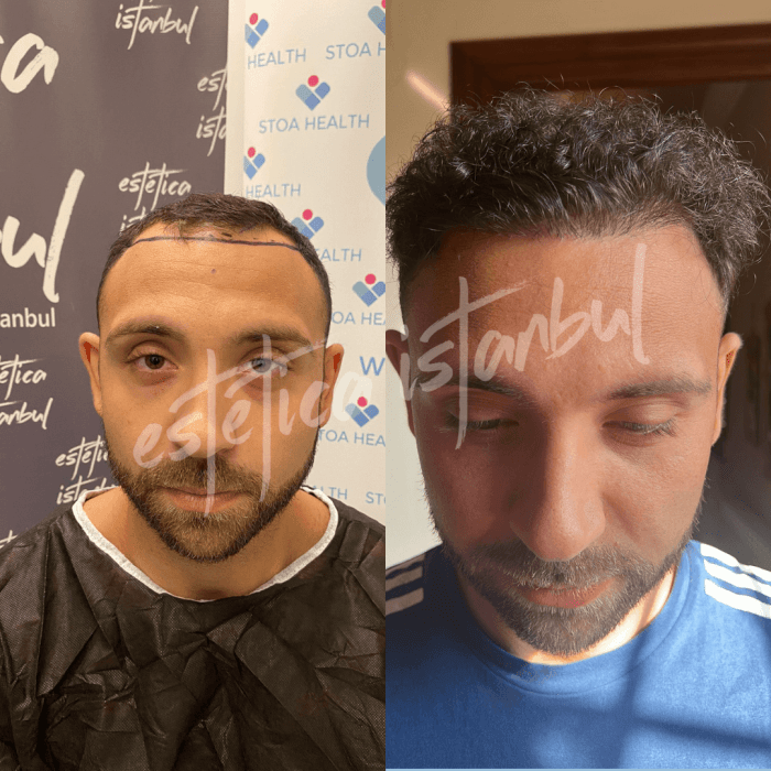 Hair Transplant in Turkey - Estetica Istanbul Aftercare tips for hair transplant patients in Turkey